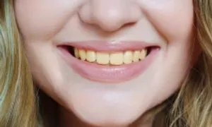 Màu sắc răng tiết lộ điều gì về sức khỏe?